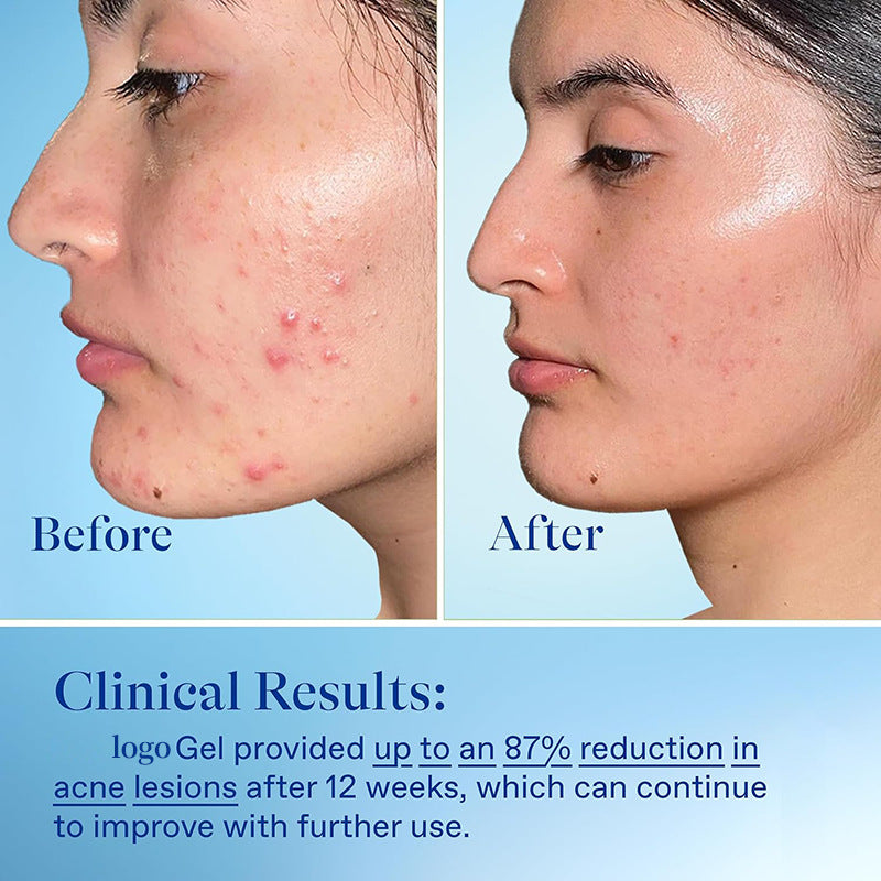 Freckle Removing Treat Acne Gel